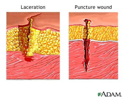 Skin glue to close incisions and lacerations