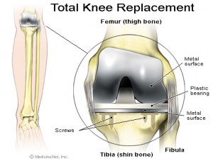 Total Knee Replacement Surgery (Total Knee Arthroplasty)