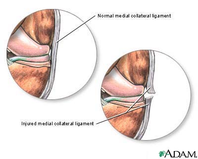 MCL Injury A Common Cause Of Medial Knee Pain